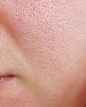 Enlarged Pores