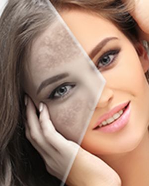Hyperpigmentation